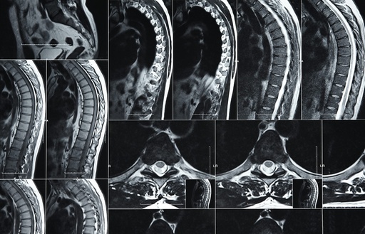 TotalView™ Lumbar Precision