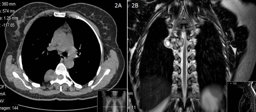 TotalView™ Thoracic (Chest)