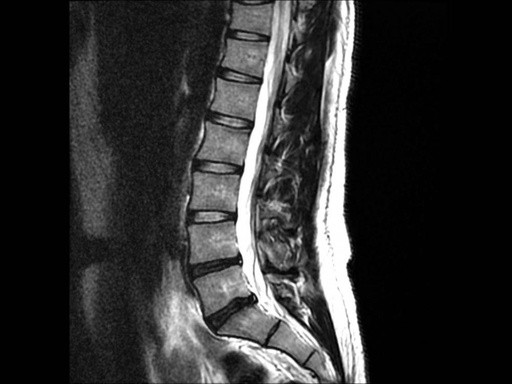 Lumbar Spine MRI (for Dr. Martínez Canca patients only)